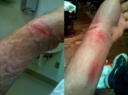 Drew Carey's Injured arm