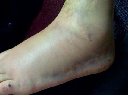 Pete Wentz's broken foot