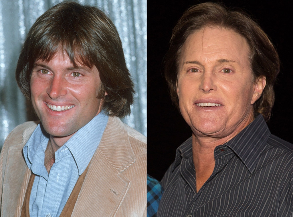 Bruce Jenner, Plastic Surgery Before And After Bruce Jenner, Plastic Surgery Before And After