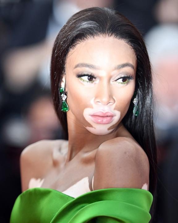 Winnie Harlow Winnie Harlow