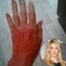 Brandi Glanville, Burned Hand