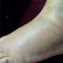 Pete Wentz's broken foot